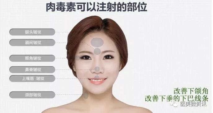 肉毒素祛皱每个部位用量,肉毒素祛皱注意事项