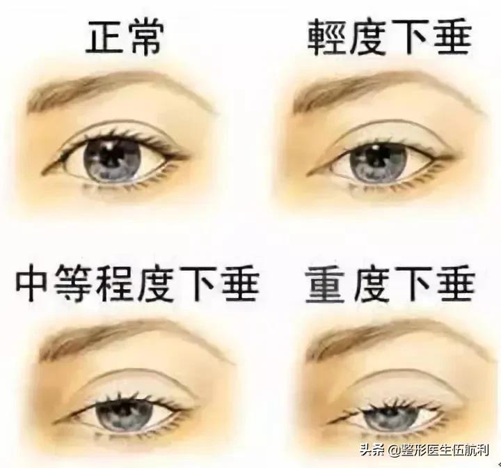 眼睛小应该做哪些眼综合手术,眼睛不对称怎么矫正医美