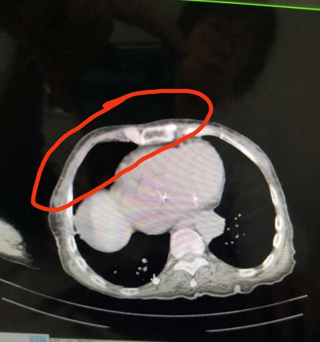 肝硬化腹水中药治好病例,肝硬化腹水中医辨证论治