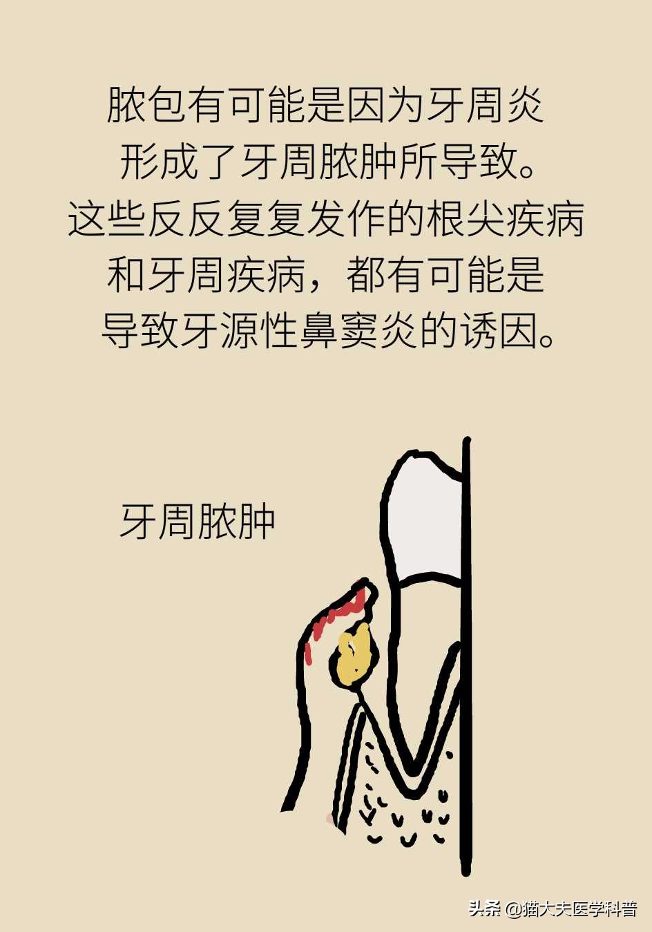 鼻窦炎引起的牙龈肿痛,牙龈引起的鼻窦炎怎么治疗