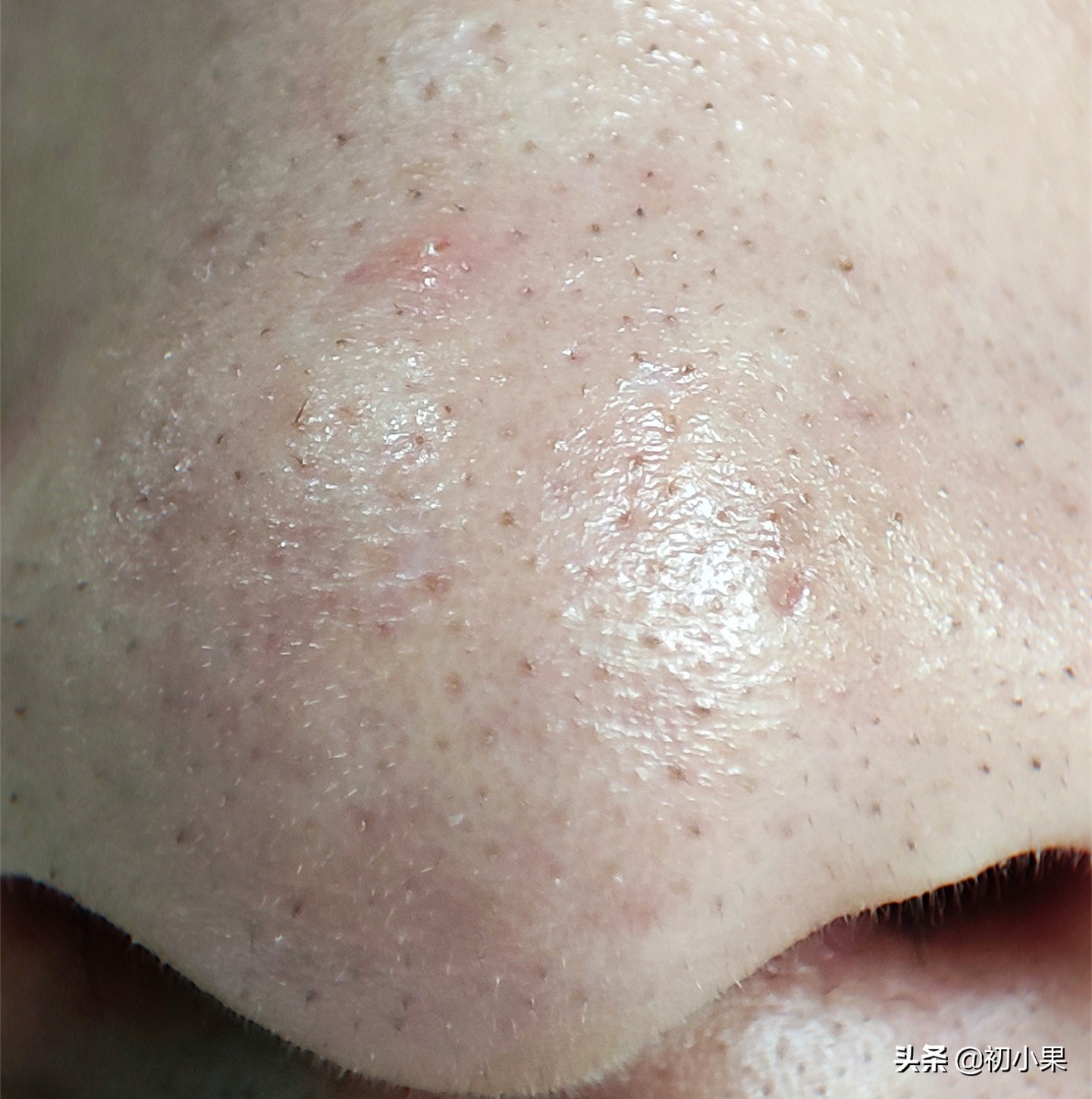 鼻子上的黑头怎么去除,鼻子上的黑头怎么去除小孩