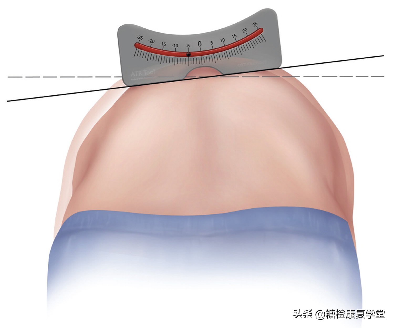 什么运动可以矫正脊柱侧弯,脊柱侧弯做什么运动最好