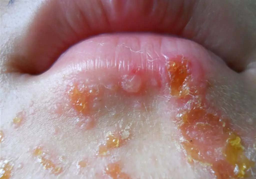 夏季常见皮肤病有哪些,谨防五种夏季高发病