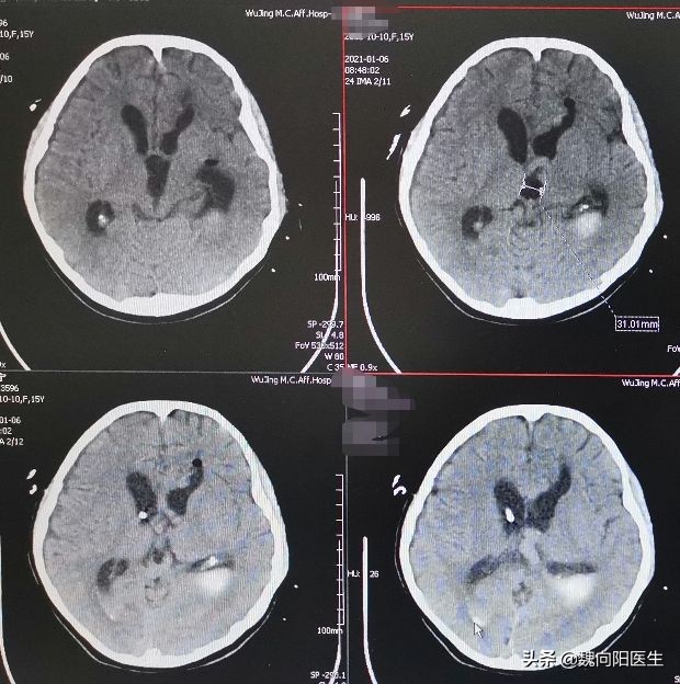 脑出血后脑子里血满了还能治吗,脑出血患者脑子恢复挺好能醒吗