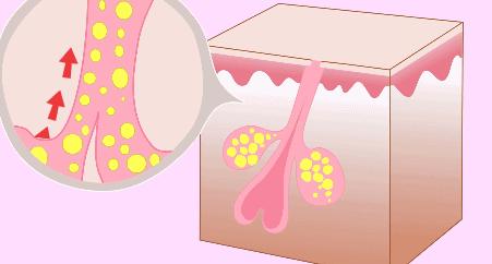 毛孔粗大如何改善最有效的方法,毛孔粗大目前最有效的方法