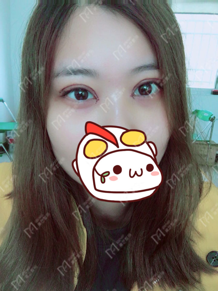 双眼皮割宽了怎么化妆,割双眼皮最宽能割几毫米