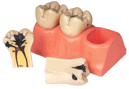 蛀牙可以怎么有效的缓解蛀牙程度,蛀牙了认真刷牙会停止蛀牙吗