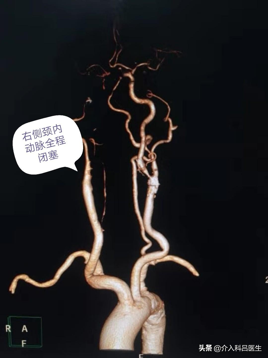 86岁左侧颈内动脉狭窄怎么办,75岁颈动脉狭窄81%咋样治疗