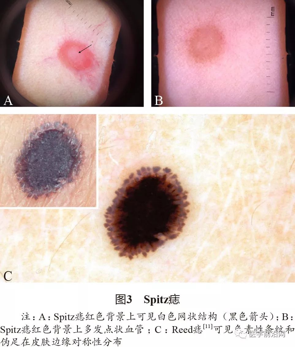 面部常见皮肤病皮肤镜诊断专家共识全文发布