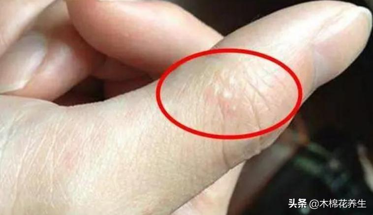 手上长小水泡很痒可以把泡刺破吗,手上起的小水泡很痒怎么快速消除