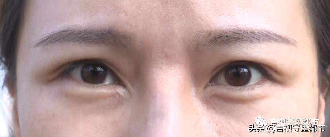 鼻综合三万块钱贵吗,一万块可以做鼻综合吗