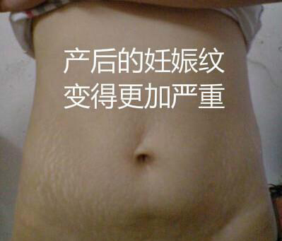 肥胖纹大腿上怎么消除,大腿很多肥胖纹怎么消除