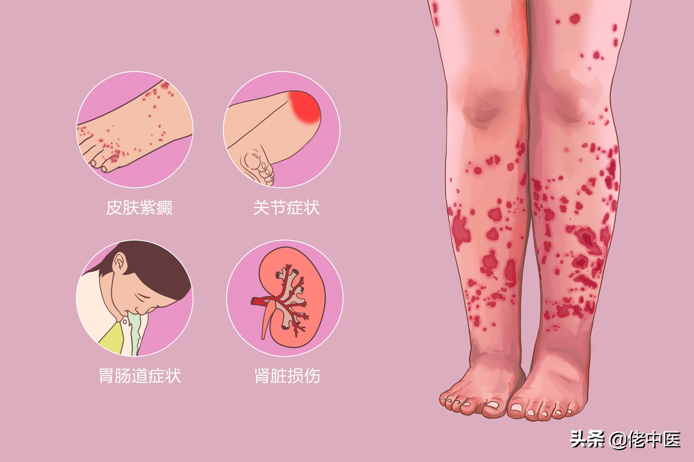 紫癜肾炎出现紫癜属于复发了吗,紫癜性肾炎复发会有紫癜出现吗