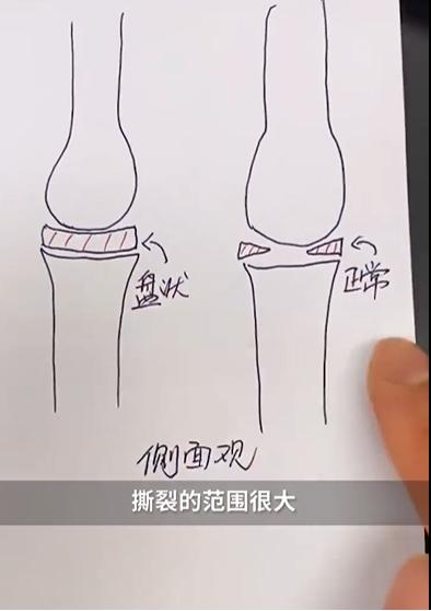 高位截瘫小孩10岁康复训练,小孩高位截瘫功能锻炼