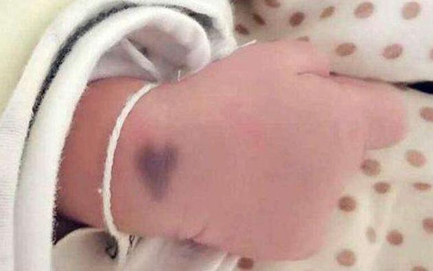 为什么刚出生的婴儿屁股上有青迹,为什么婴儿出生屁股会淤青