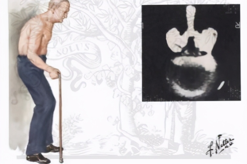 腰椎管狭窄有什么症状怎么样治疗,腰椎管狭窄是怎么引起的如何治疗