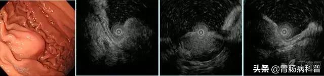胃癌手术后一年胃镜说胃粘膜隆起,胃镜报告有隆起