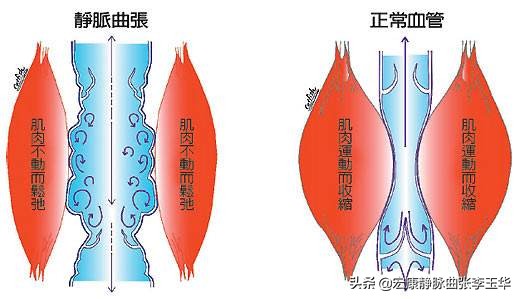 血管变粗就是静脉曲张？你了解的静脉曲张是怎样的？