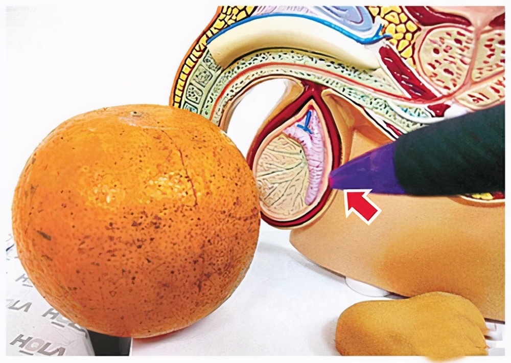 睾丸附睾炎是精索静脉曲张吗,精囊腺炎和精索静脉曲张看什么科