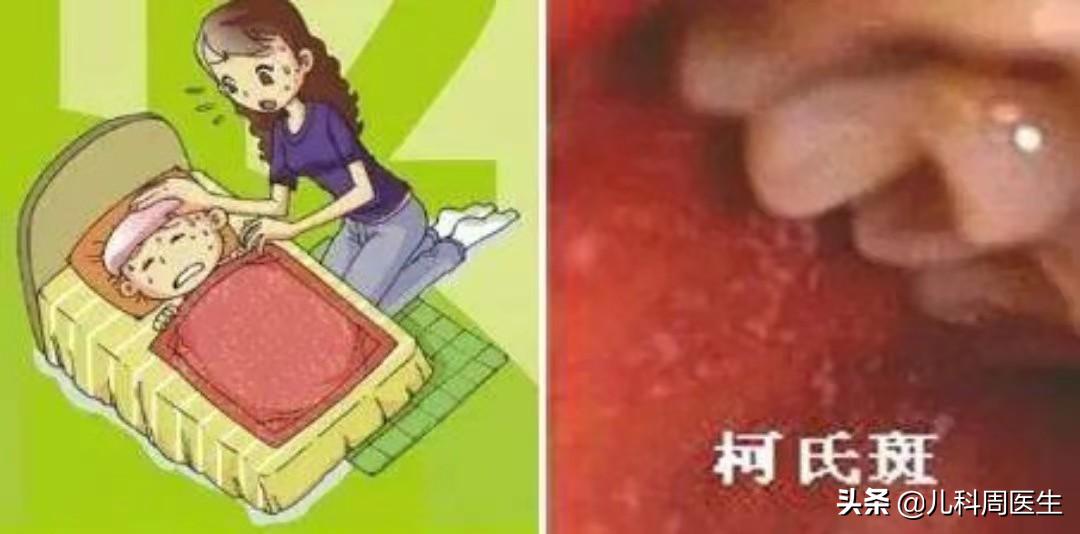 春天起水痘,如何辨别水痘和麻疹