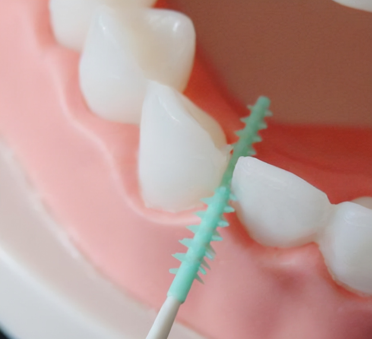 戴了牙套每天清洁牙齿小知识,牙套期间为什么要保持口腔卫生