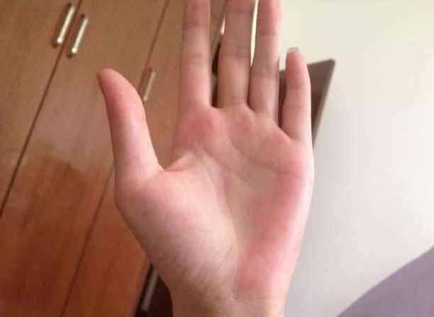 肝病老中医治愈乙肝,乙肝大三阳肝病能治好么