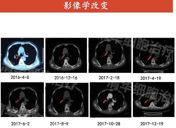 肺癌晚期活不了多久的症状,肺癌晚期生命只剩下六个月