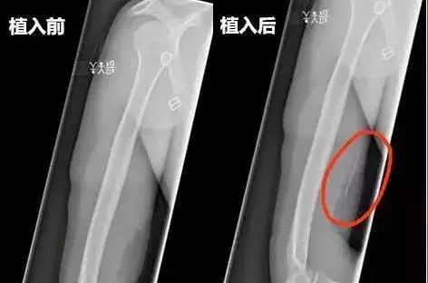 小小一根棒，比套套和上环安全，避孕率超高却少有人知道...