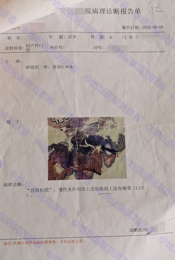 hpv感染多久会发生cin2级病变,hpv感染cin1病变塞药能好吗