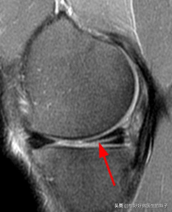 半月板撕裂手术后怎么自己做康复,半月板撕裂手术最佳自愈方法