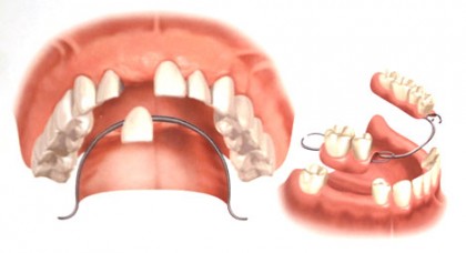 活动假牙和固定假牙的优缺点ppt,活动假牙和固定假牙哪个贵
