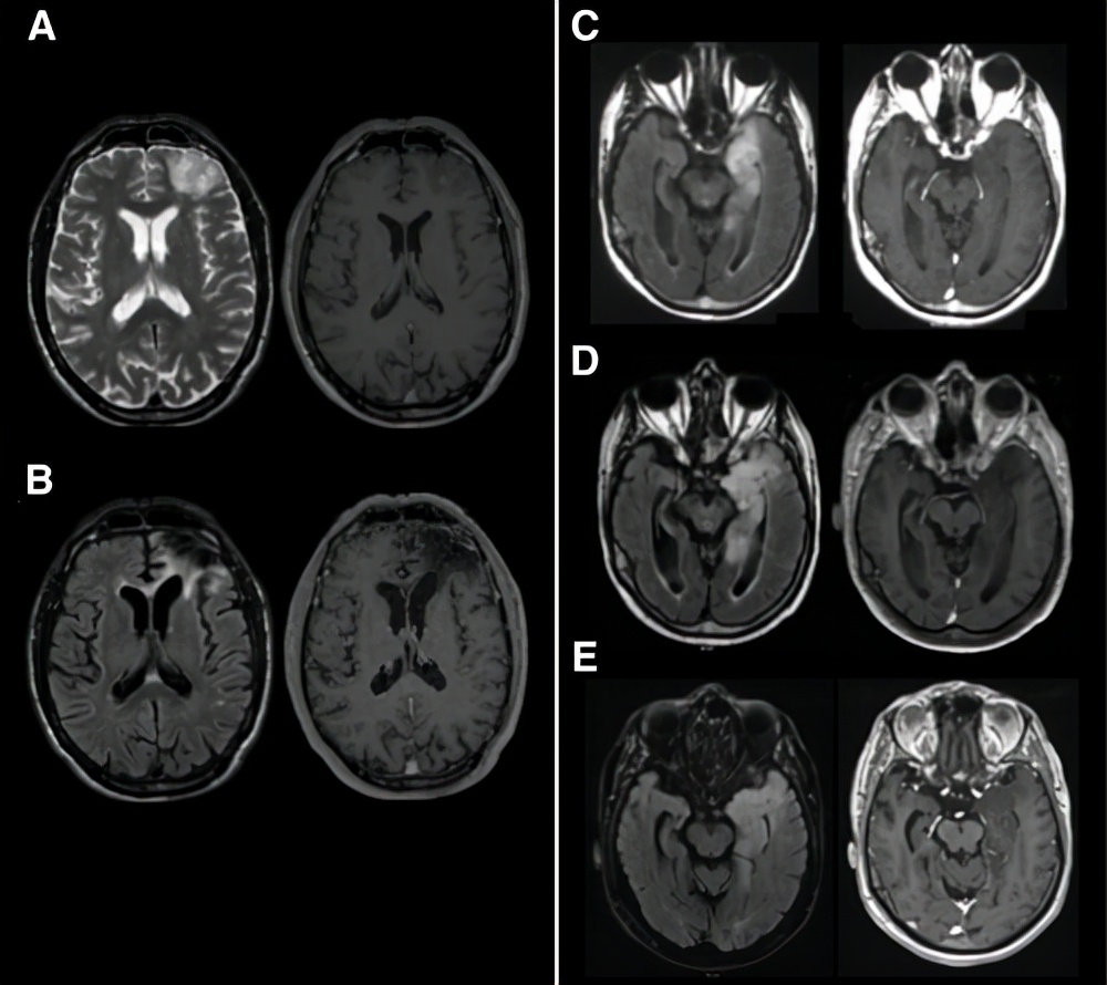 82岁胶质瘤保守治疗病情发展过程,高龄胶质瘤能用鸡尾酒疗法吗