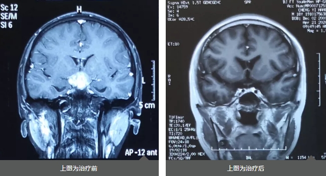 生殖细胞瘤发病机理,生殖细胞瘤的发病位置