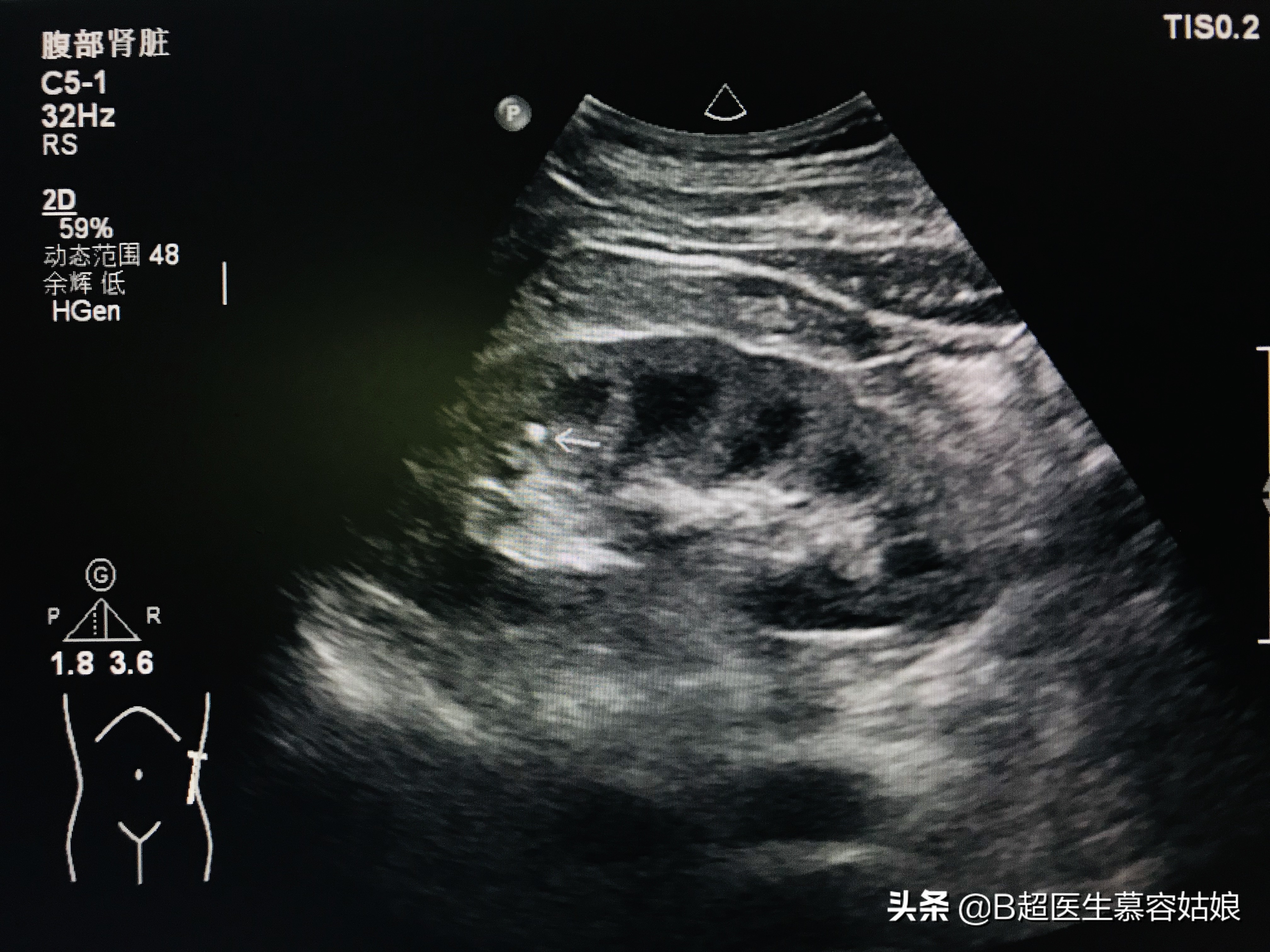 肾结石为什么这么痛怎么处理,为什么会得肾结石疼痛怎么缓解