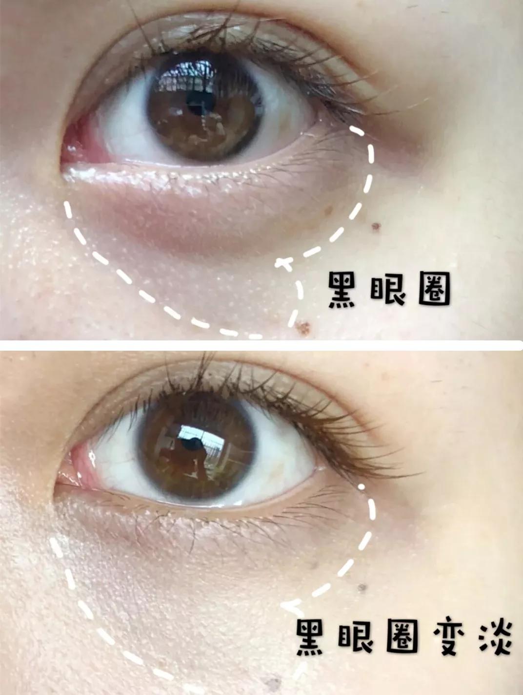 脂肪粒别用针挑教你一个土办法,脂肪粒怎么用针挑出来不疼