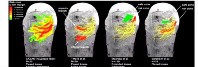 膝关节置换术后神经阻滞,膝关节置换后的神经阻滞怎样做
