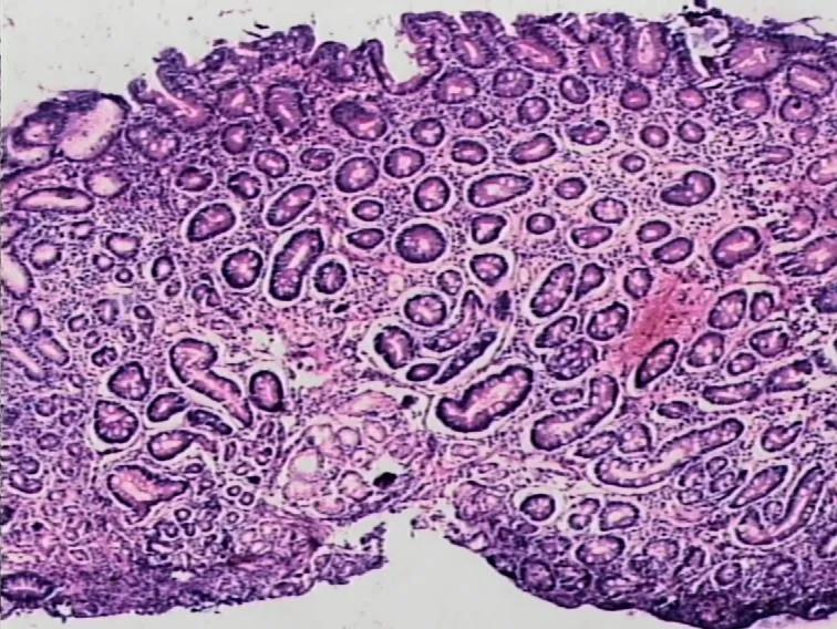 胃息肉癌变怎么治疗,胃息肉一定会癌变吗