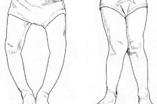 佝偻病是因为缺钙吗,孩子佝偻病是咋回事