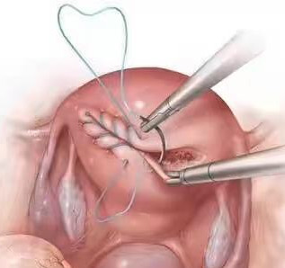 子宫疤痕是不是剖腹产的疤痕,瘢痕子宫是不是剖宫产留下的疤