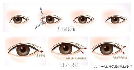 眼综合是前内眼角还是外眼角,双眼皮开内眼角和外眼角的区别