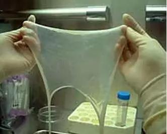 宫腔镜羊膜移植术多久能下地,重度宫腔粘连试管成功率高吗