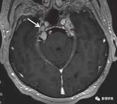 头部t1wi信号不均匀增高,脑t1wi和t2wi稍低信号