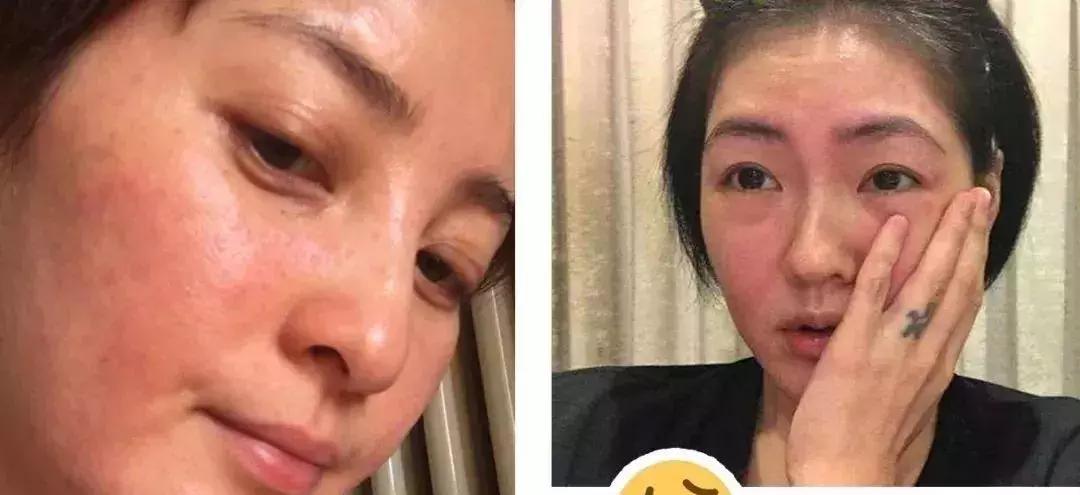 过敏的化妆品怎样处理,过敏性皮炎化妆品过敏怎么办