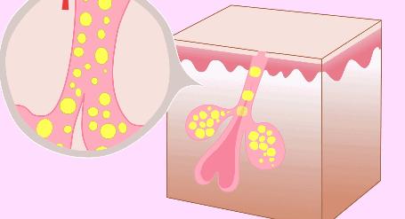 脸上戴口罩闷痘如何快速消除,长期戴口罩闷痘用什么护肤品