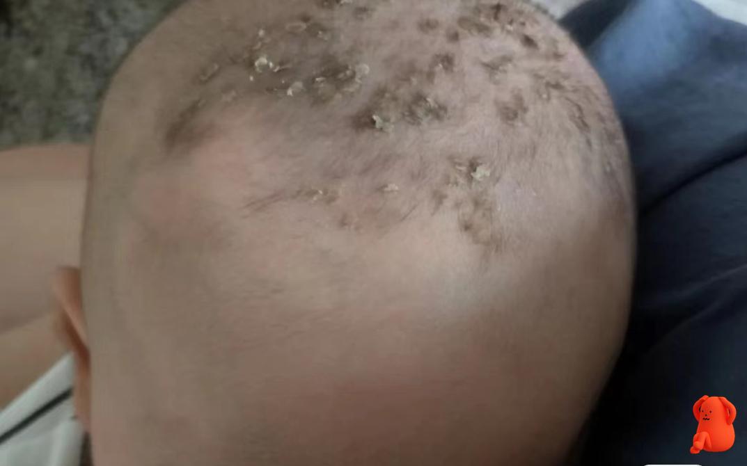 宝宝乳痂怎么去除,手贱扣痂会留印吗