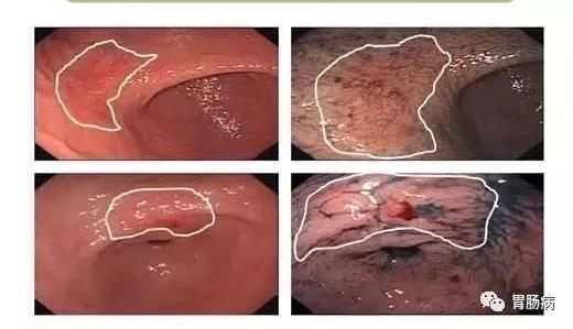 早期中低分化腺胃癌能治好吗,早期胃癌能治好吗怎样治