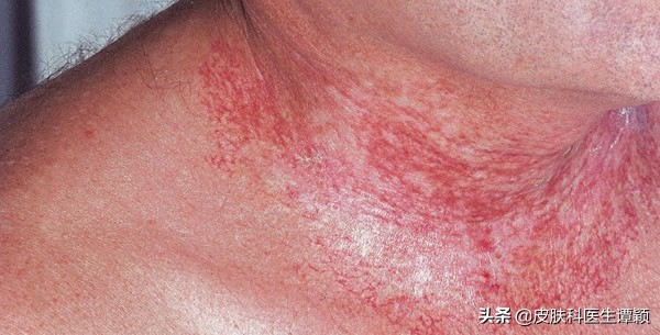 皮肤科医生神经性皮炎,预防放射性皮炎最基本的护理措施