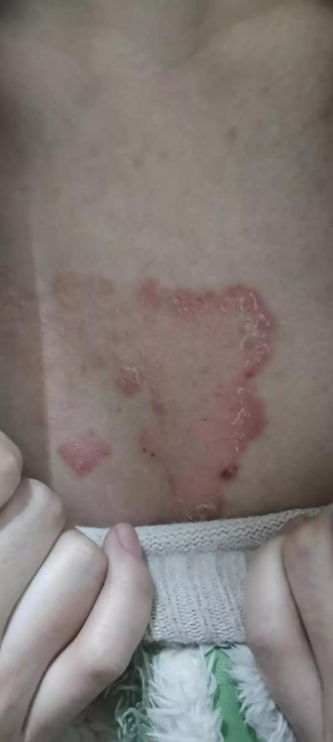 住海南就能使牛皮癣不治自愈吗,牛皮癣和体质有关系吗