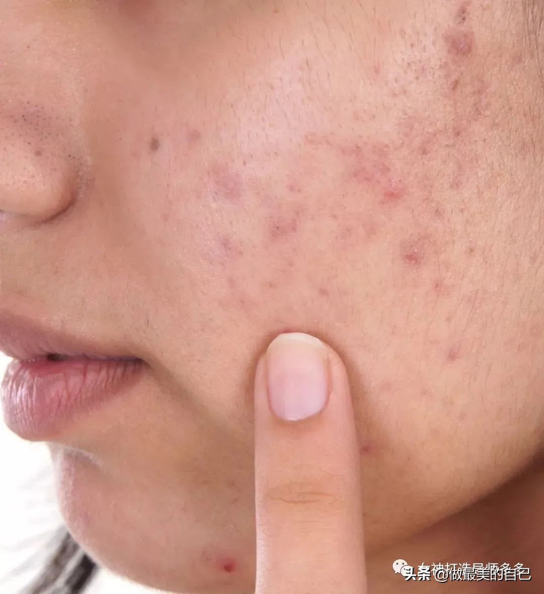 痘印长期不消怎么办,痘印反复消不下去怎么办