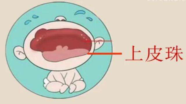 新生儿诞生牙案例,婴儿出生时已萌出的牙齿